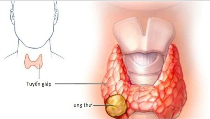 Hình ảnh minh họa u tuyến giáp ở cổ