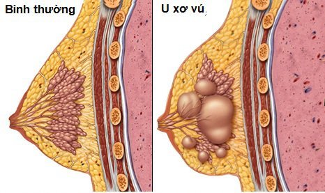 Minh họa tầm soát u tuyến vú bằng siêu âm